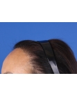 After Hair Transplant&nbsp;Hairline